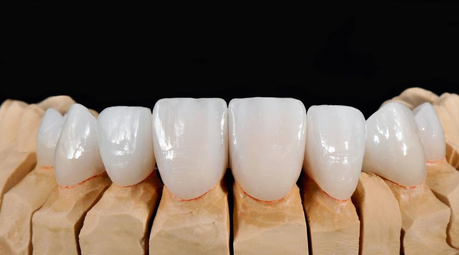 ventajas de las carillas dentales