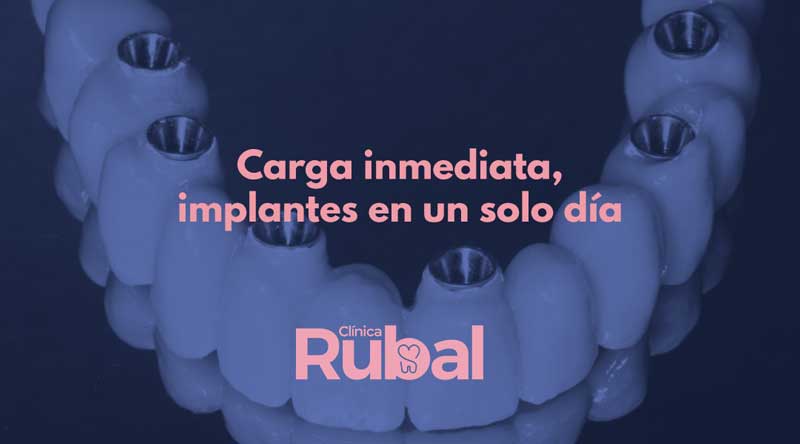 Carga inmediata. implantes en un solo día | Rubal Dental