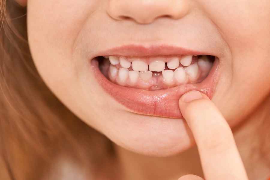 ¿Qué son los dientes de leche? | Rubal Dental