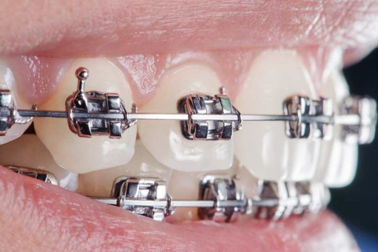 Gomas de los brackets, todo lo que necesitas saber sobre ellas