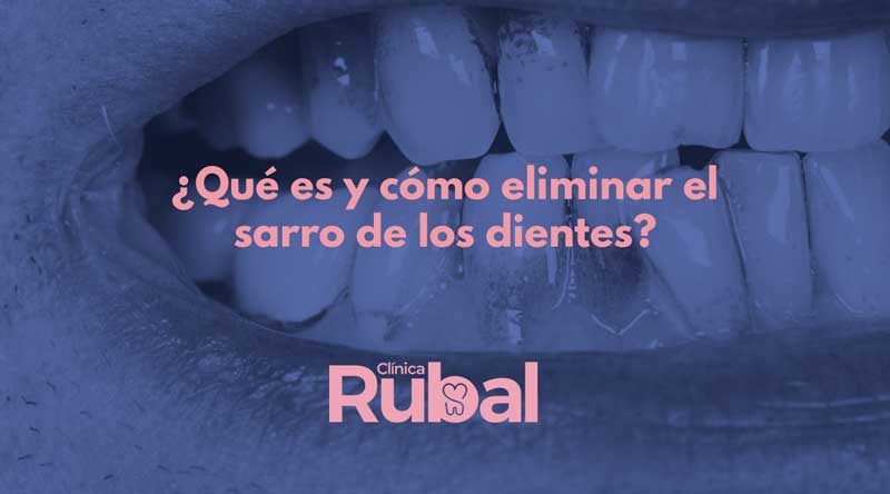 ¿Qué es y cómo eliminar el sarro de los dientes? | Rubal Dental