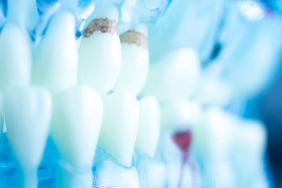 ¿Qué es el sarro dental? | Rubal Dental