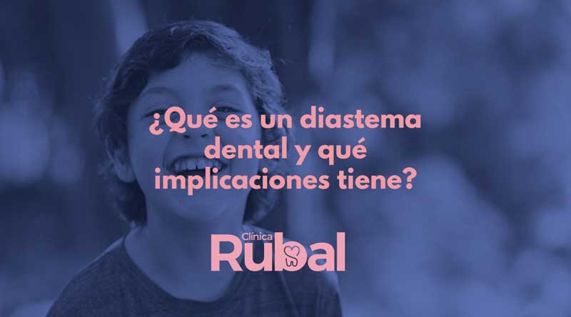¿Qué es un diastema dental y qué implicaciones tiene? | Rubal Dental