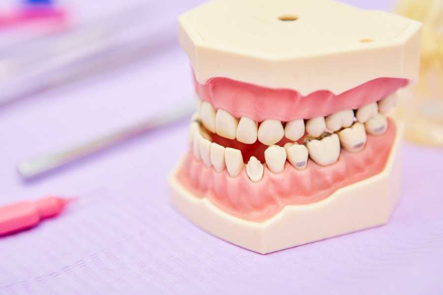 ¿Qué es una maloclusión dental?