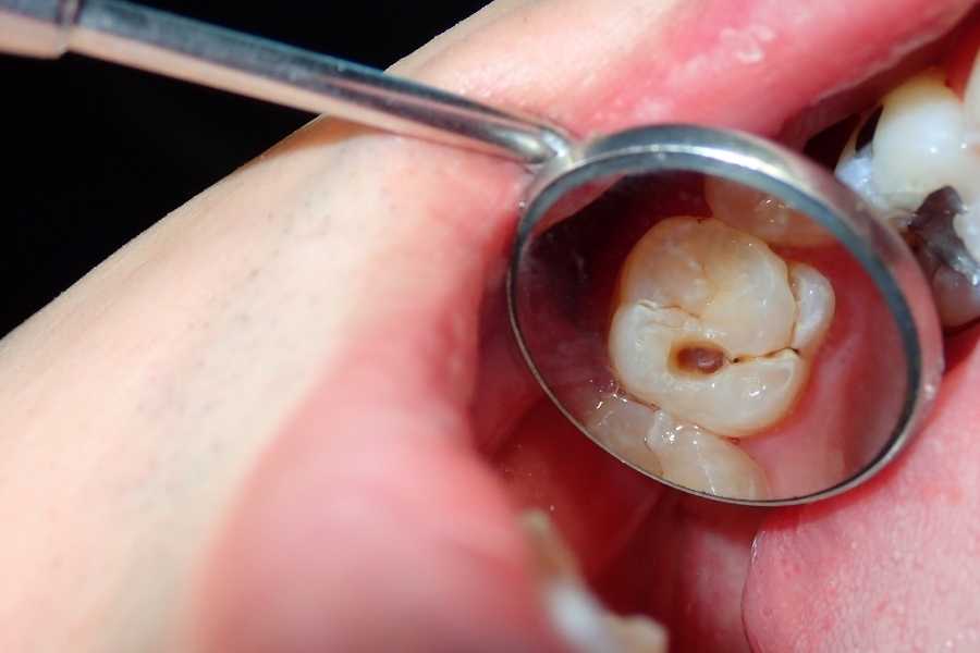 Causas de aparición de la maloclusión dental