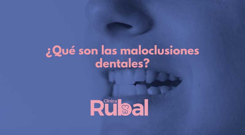 ¿Qué son las maloclusiones dentales? | Rubal Dental
