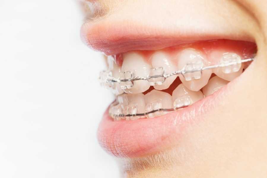 Tratamiento de las maloclusiones dentales
