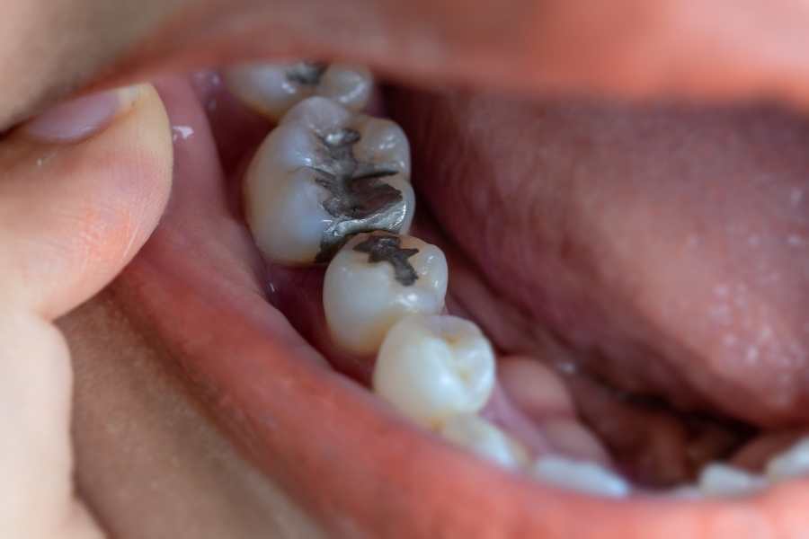 Clave para la prevención de caries | Rubal Dental