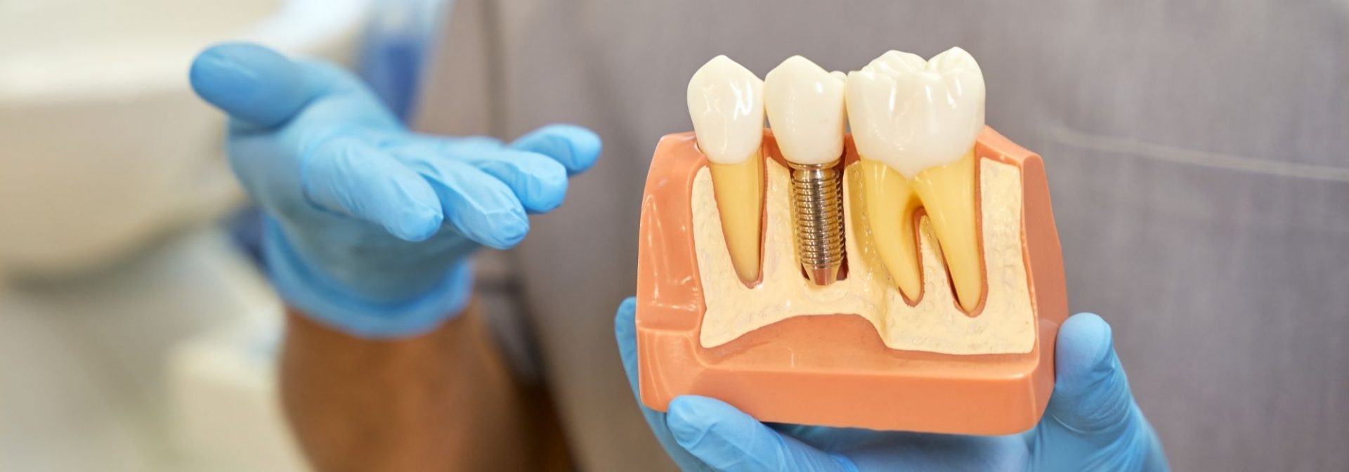 Implante dental en Málaga | Rubal Dental
