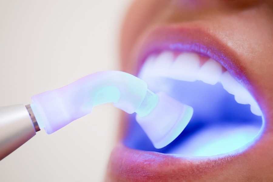 ¿Qué materiales se utilizan para un empaste dental?