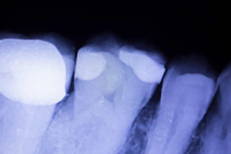 ¿Qué es un empaste dental?