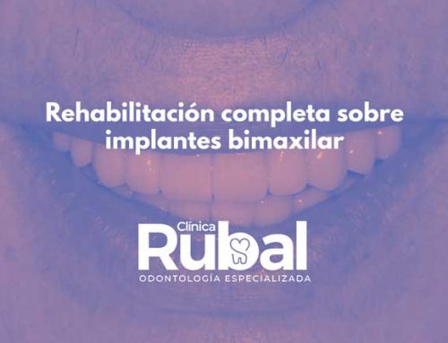 Rehabilitación completa sobre implantes bimaxilar