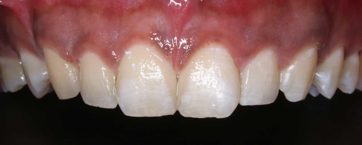 Composites estéticos para restaurar dientes con caries en zona estética | Rubal Dental