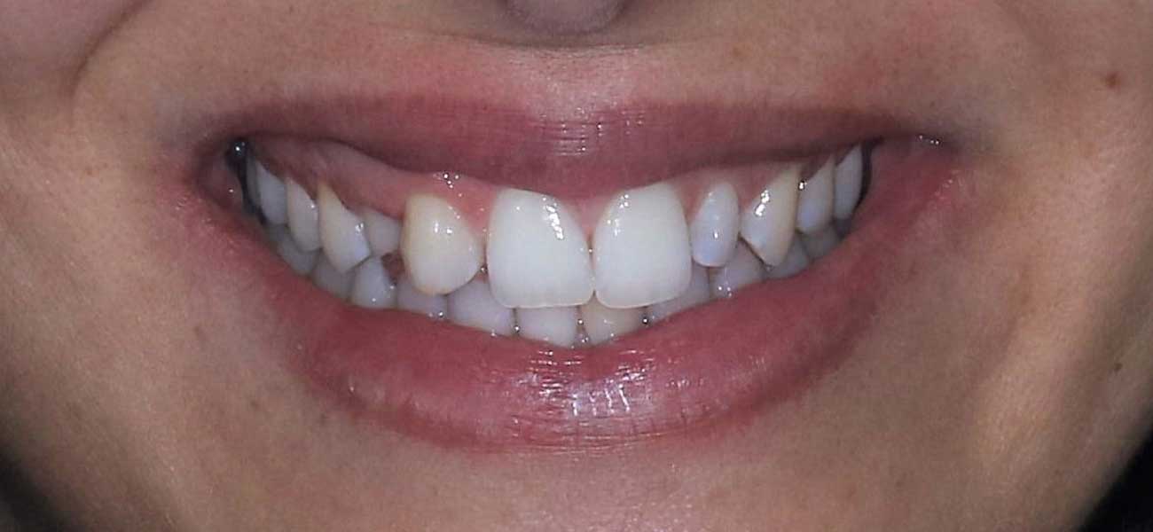 Falta de diente permanente y transposición de colmillo | Rubal Dental