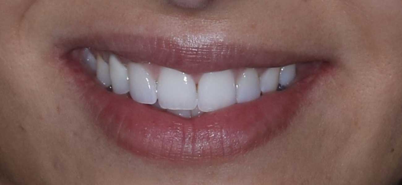 Falta de diente permanente y transposición de colmillo | Rubal Dental