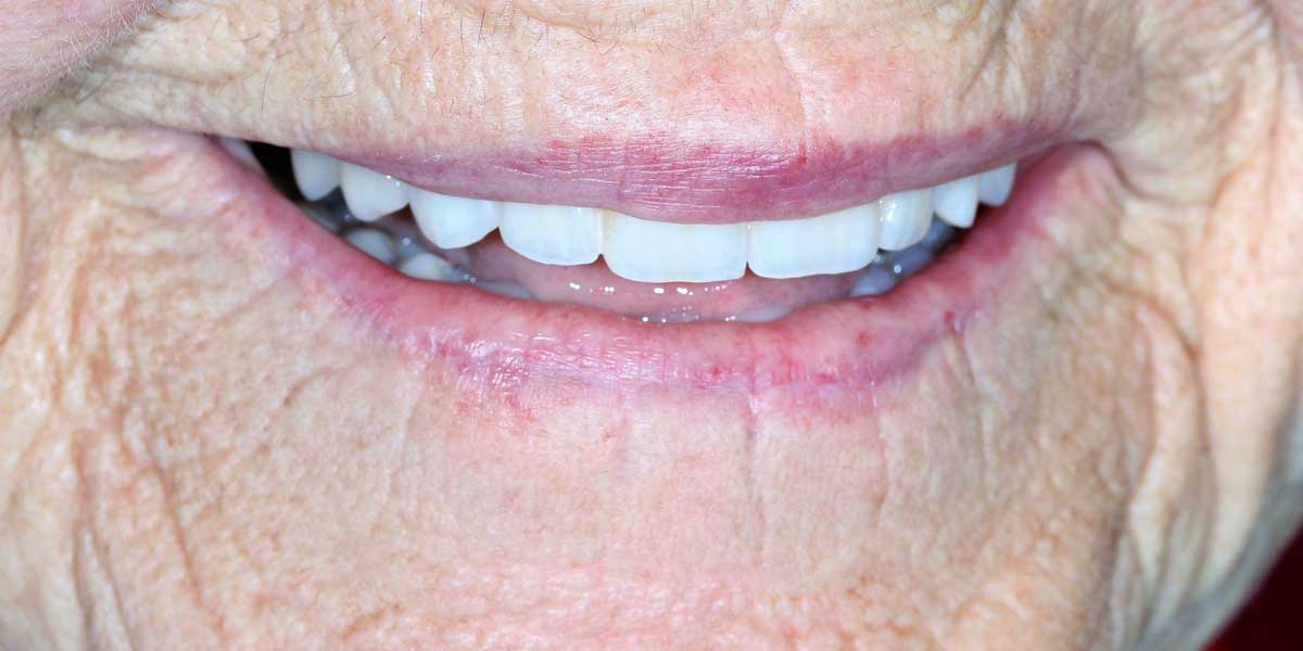 Rehabilitación completa fija sobre dientes con implantes