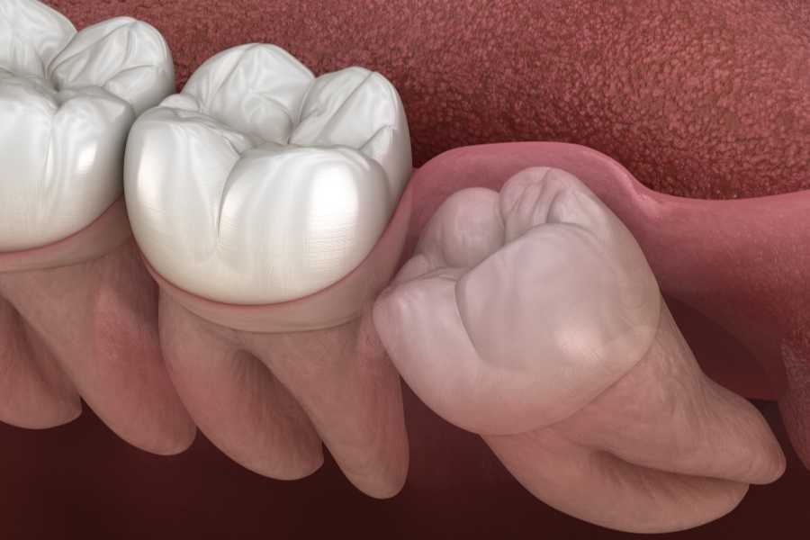 Apiñamiento dental terciario | Rubal Dental