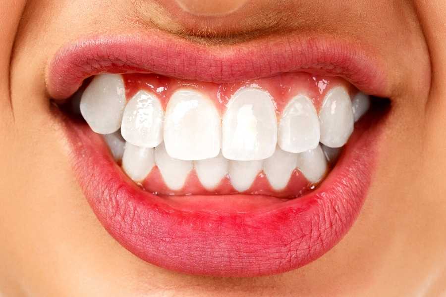 Bruxismo, una de las causas de la sensibilidad dental | Rubal Dental