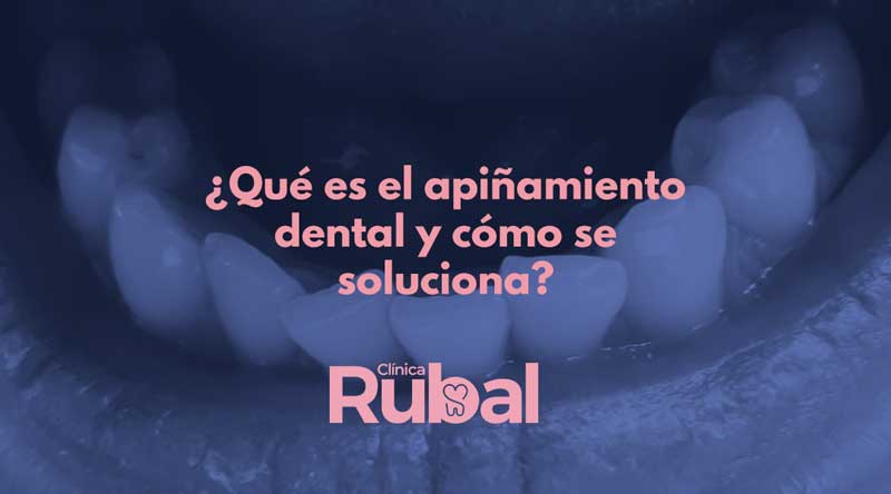 ¿Qué es el apiñamiento dental y cómo se soluciona? | Rubal Dental