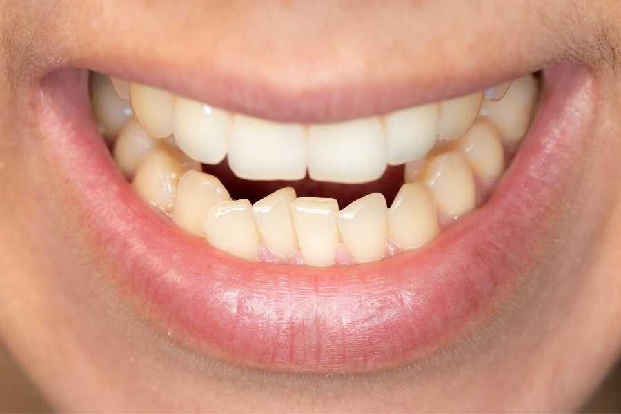 ¿Qué es el apiñamiento dental? | Rubal Dental