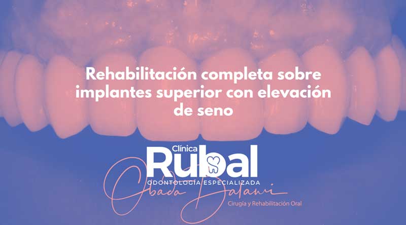 Rehabilitación completa sobre implantes superior con elevación de seno | Rubal Dental