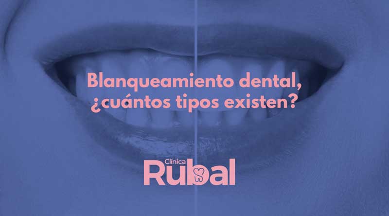 Blanqueamiento dental, ¿cuántos tipos existen? | Rubal Dental