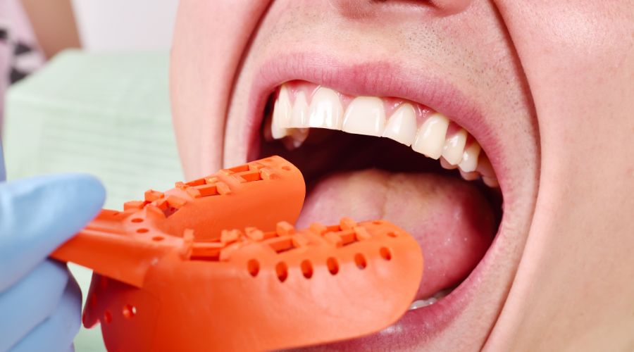 tipos blanqueamiento dental