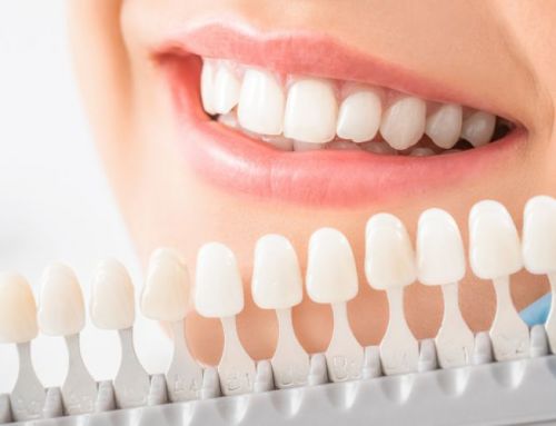 Dientes blancos: cómo conseguir el máximo brillo