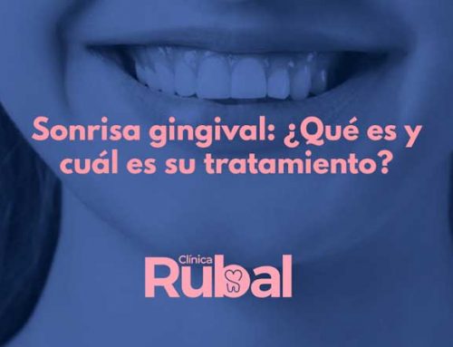Sonrisa gingival: ¿Qué es y cuál es su tratamiento?