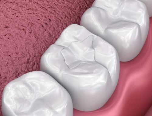 Resina dental: qué es, ventajas y desventajas