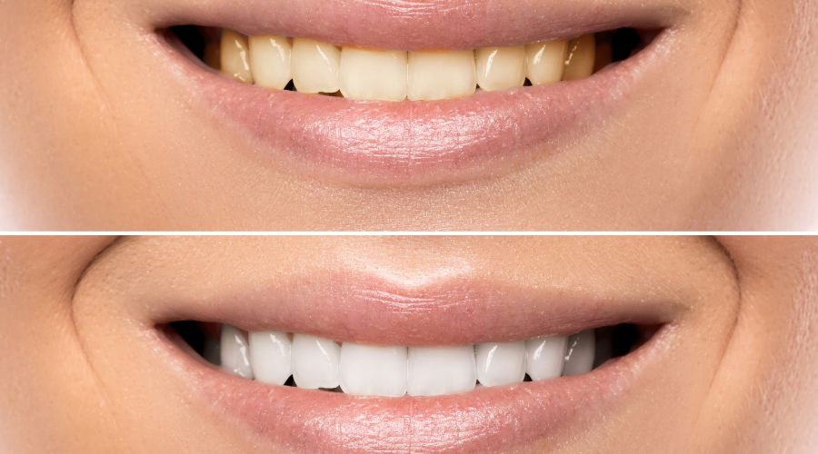 Tratamiento de blanqueamiento dental antes y después