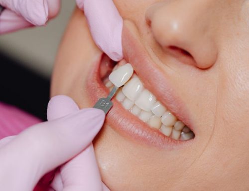 La magia del composite dental: cómo las carillas de composite transforman sonrisas a precios accesibles
