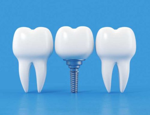 Tipos de materiales de implantes dentales: ¿cuál es mejor?