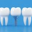 Materiales de los implantes dentales