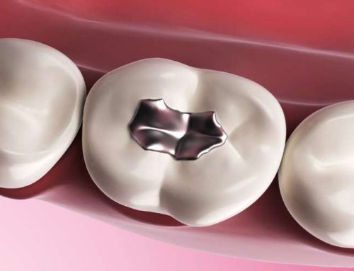 Obturación dental: tratamiento para reparar cavidades o caries dentales