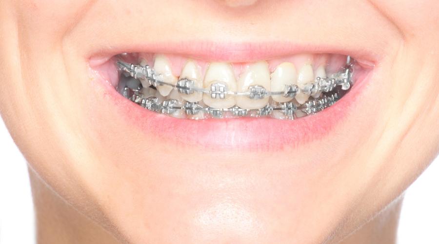Ortodoncia infantil con brackets