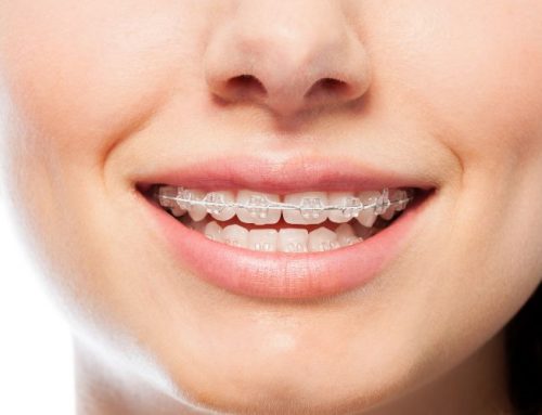 Brackets transparentes: una ortodoncia prácticamente invisible