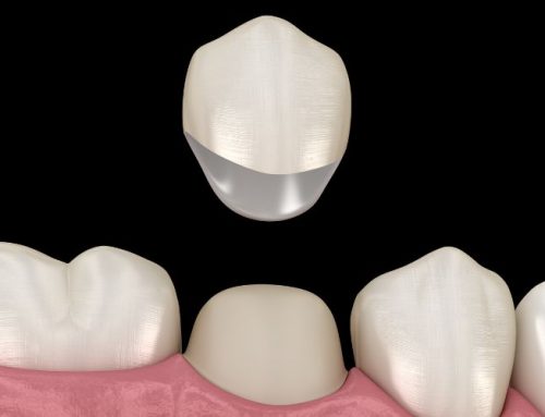 Corona dental: la guía más completa para conocer esta prótesis