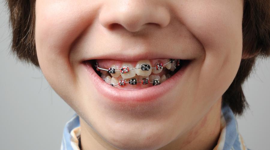 Brackets para dientes torcidos en niños