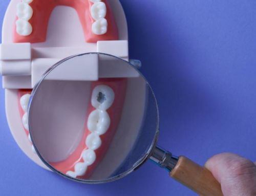 Descubre cómo detectar una pequeña caries dental en sus inicios