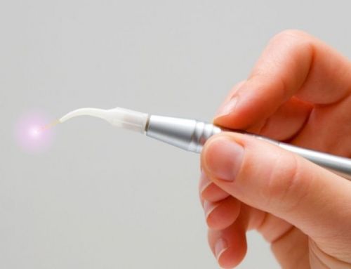 Láser dental: conoce sus utilidades en odontología