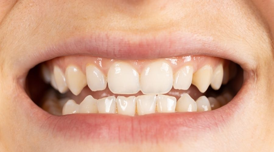 migraña dolor dientes