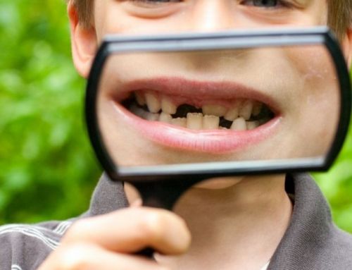 Anodoncia: 5 causas de la falta de dientes y soluciones con implantes