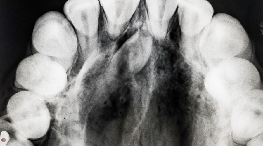 dientes supernumerarios