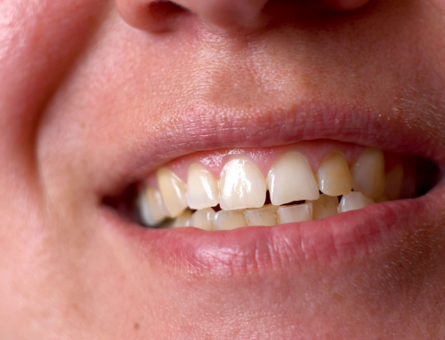 Atrición dental: 5 motivos del desgaste de dientes y las soluciones más efectivas