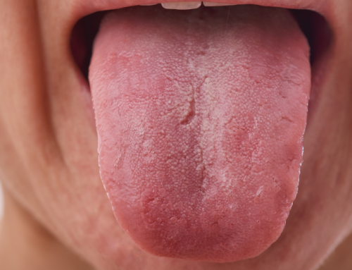 Lengua fisurada: ¿es una dolencia grave o solo un problema estético?