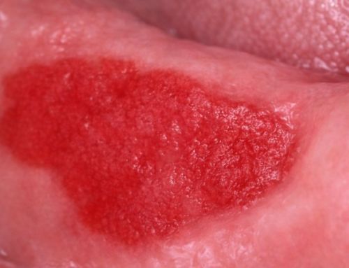 Eritroplasia oral: causas, diagnóstico y tratamiento