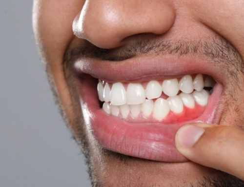 Encías rojas: causas de los puntos rojos en la encía y cómo tratar esta inflamación