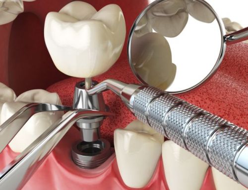 Carga inmediata, implantes en un solo día